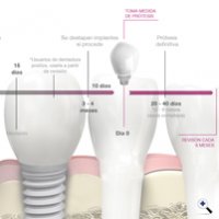 Stages of Treatment with Implants