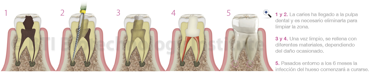 Fases de una endodoncia - Dentistas Vitoria