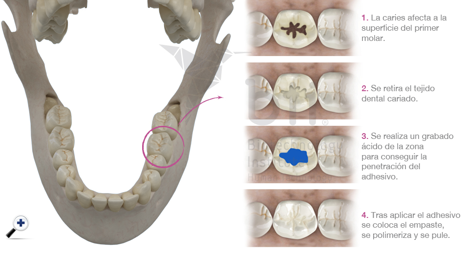 Odontología restauradora en clínica dental Vitoria