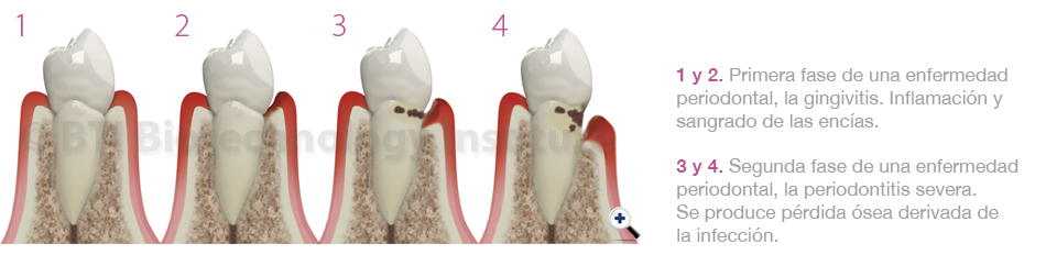 Periodontitis tratamiento dental en Vitoria